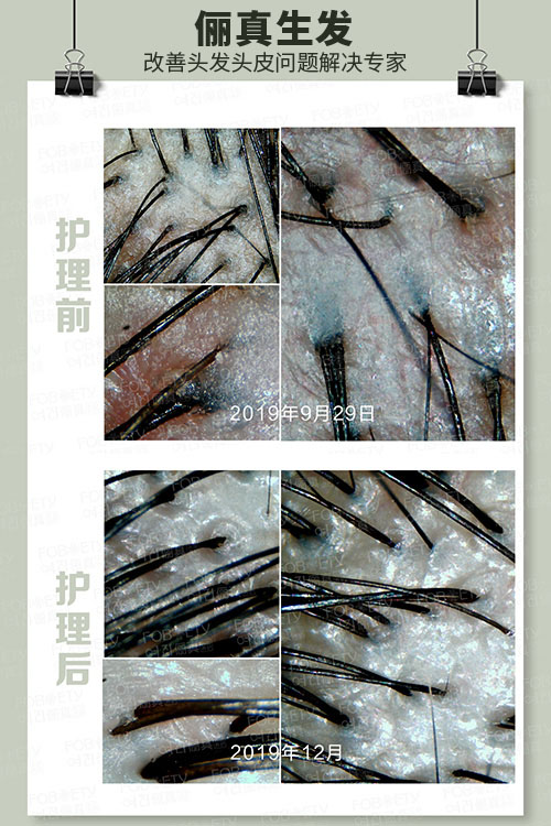 頭油、頭癢