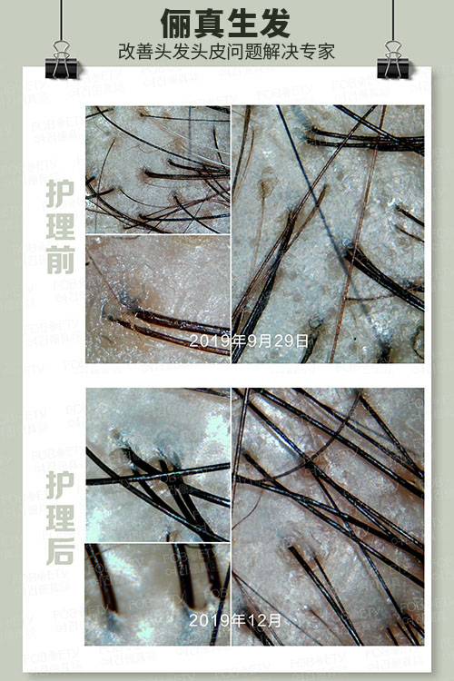 頭油、頭癢