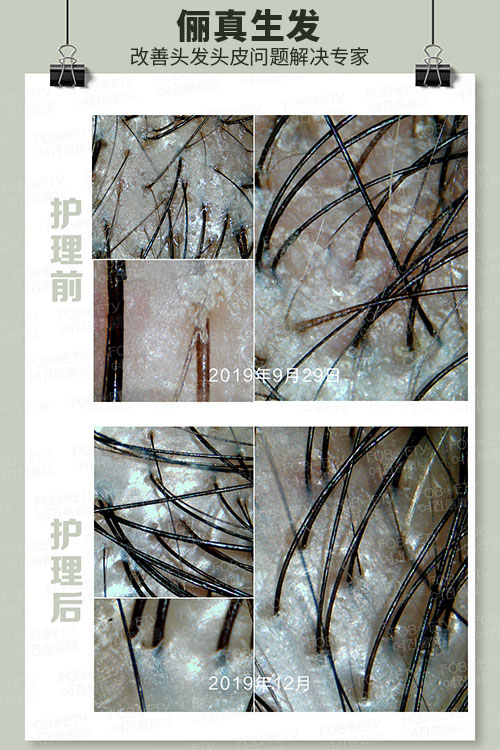 頭油、頭癢